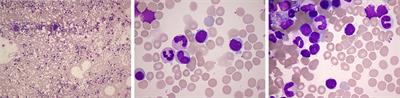 Interpreting flow cytometry with caution: A case report of follicular lymphoma in leukemic phase misdiagnosed as chronic lymphocytic leukemia